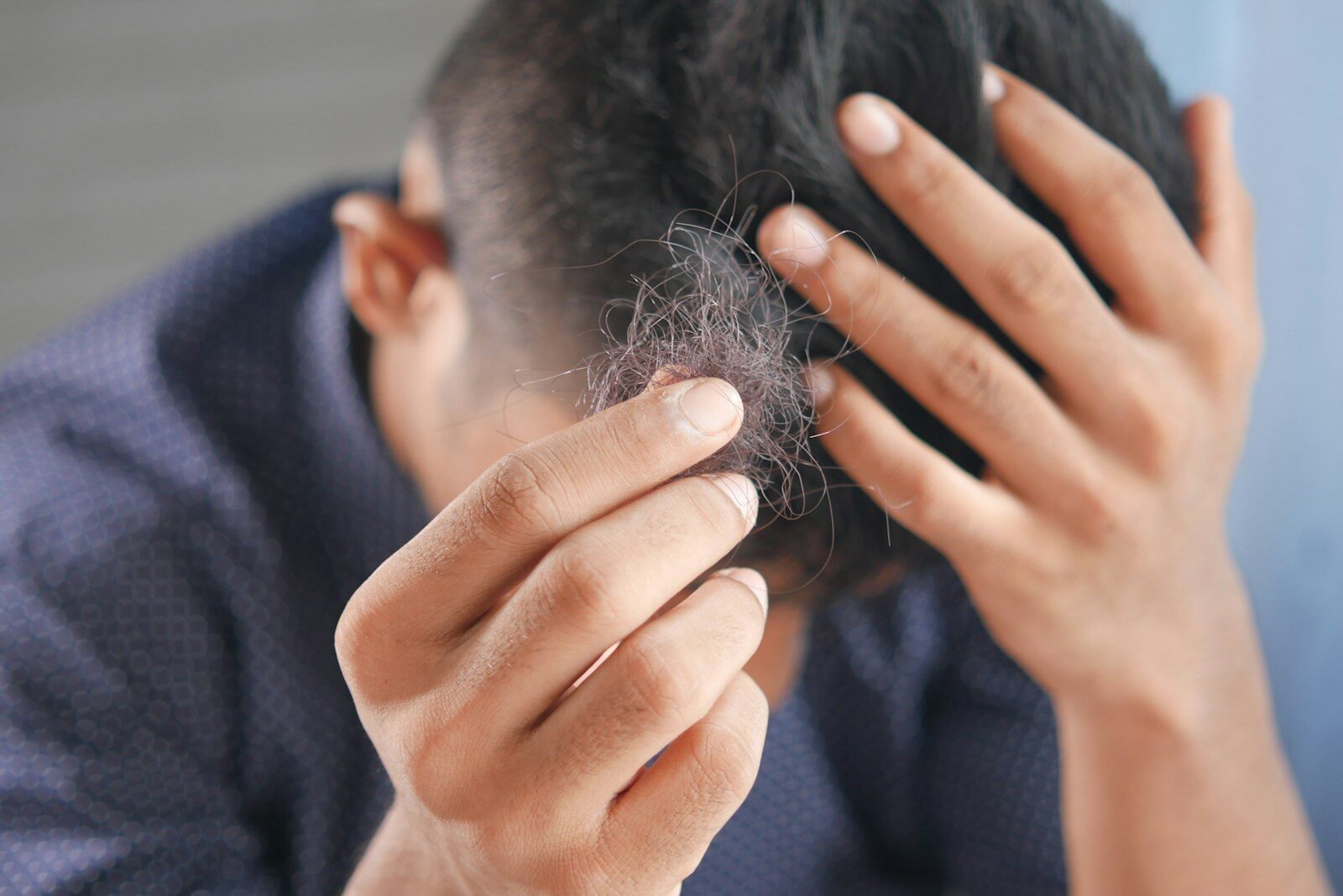 Hair Fall Due to Stress